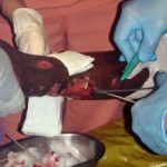 Medical treatment of severe forearm wounds