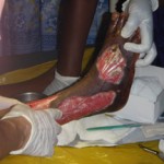 Gloved hands treating exposed muscle on leg